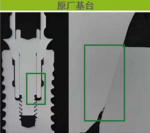 瑞士种牙品牌iti以精密工艺助力牙齿修复,绽放笑容